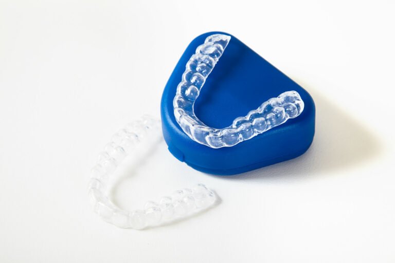 Immagine in evidenza dell'articolo intitolato: "Placche di svincolo occlusale: un approccio innovativo per il benessere dentale".